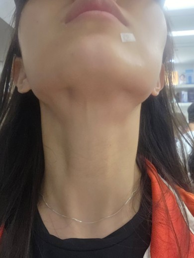 before photo: 침샘보톡스