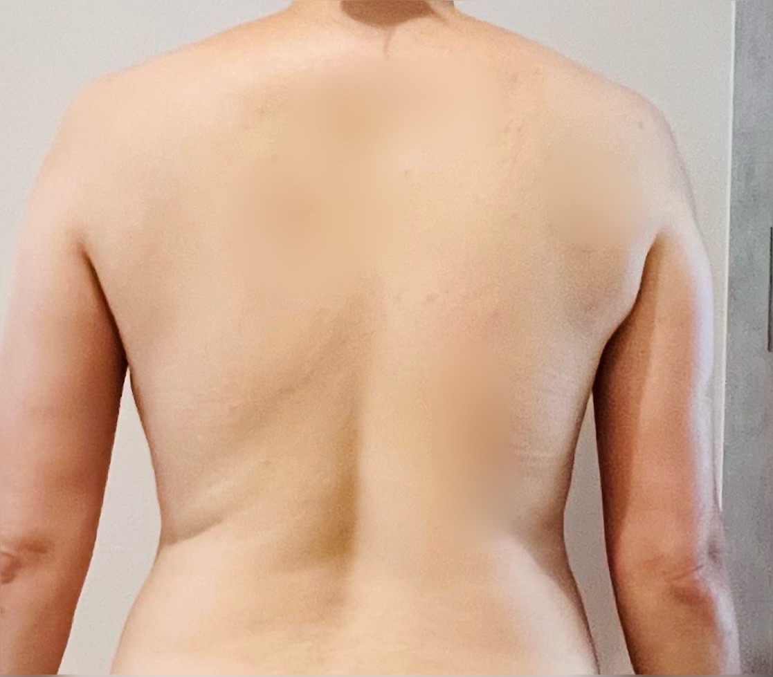 痩身・脂肪破壊】クールテックディファイン｜4カップ | REAL CLINIC