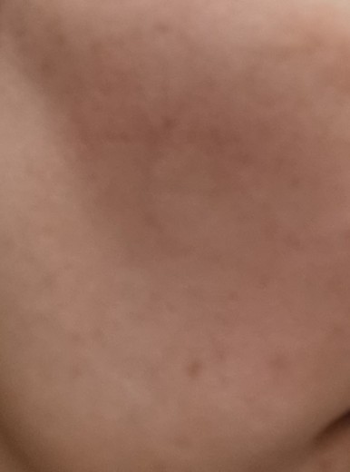 before photo: IPL(光/フォト治療)