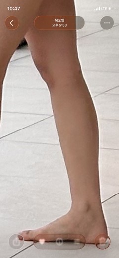 after photo: 종아리보톡스