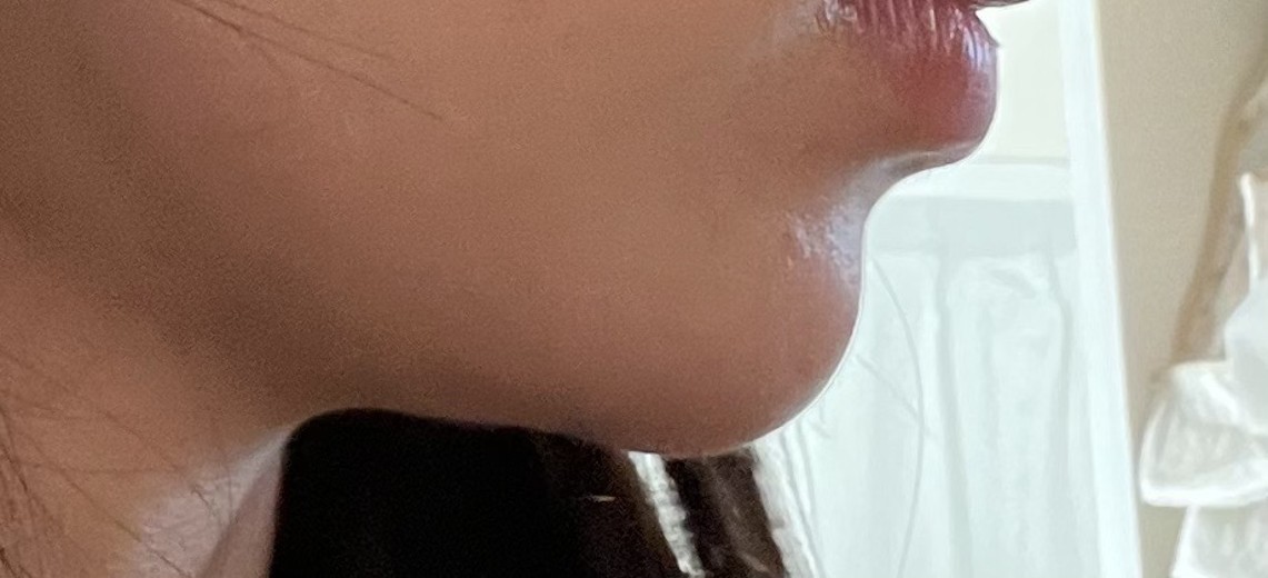 before photo: あごヒアルロン酸