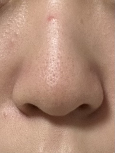before photo: 小鼻ボトックス, 脂肪溶解注射(顔)