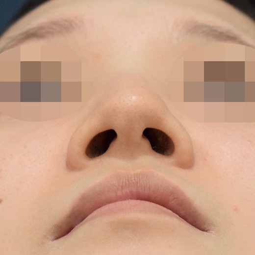 before photo: 콧볼축소