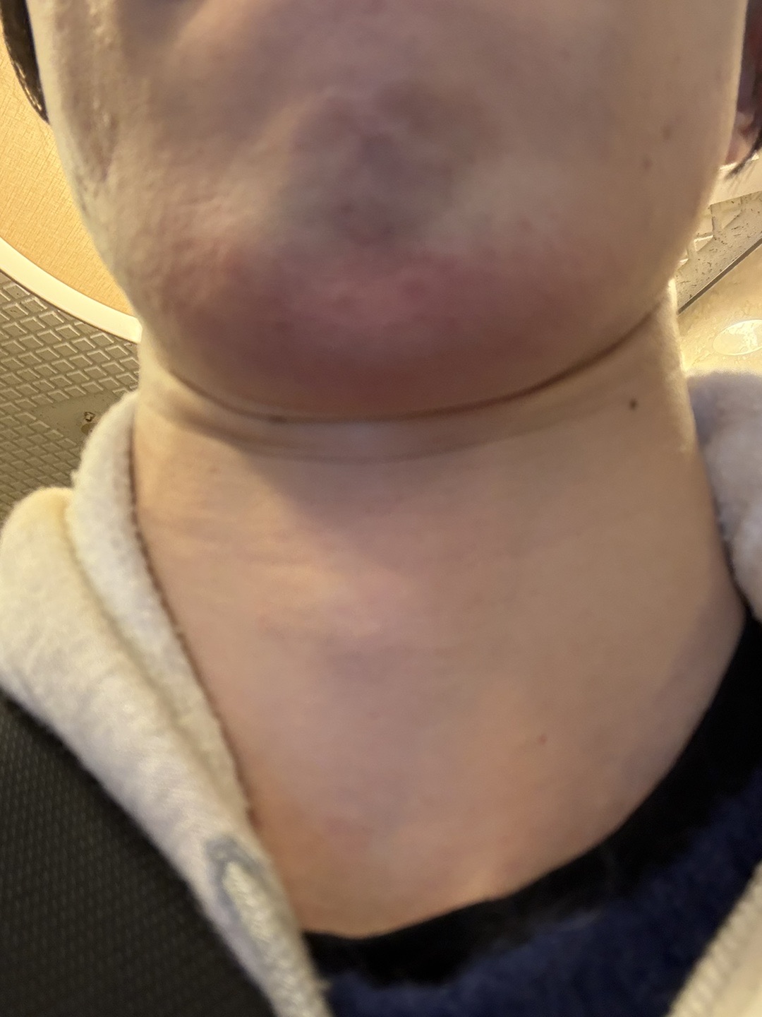 男性限定】ヒゲ脱毛（髭全体）｜ジェントルマックスプロ／ジェントル