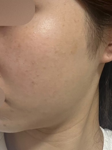 after photo: 白玉注射・点滴