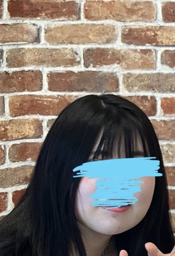 after photo: 脂肪吸引(顎下), 脂肪吸引(顔), 脂肪吸引(頬)