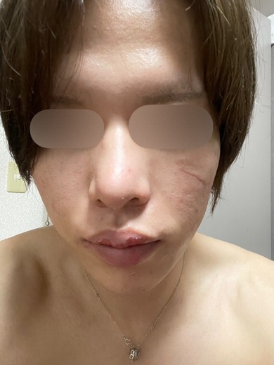 before photo: ダーマペン