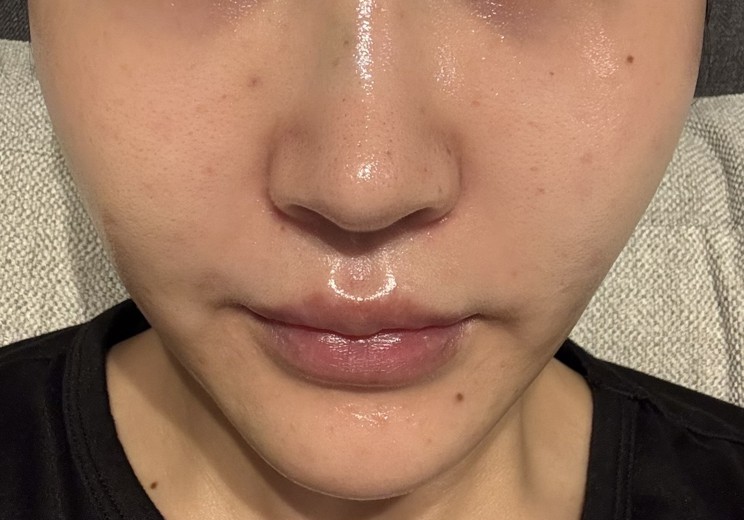 after photo: ジュベルック(Juvelook)
