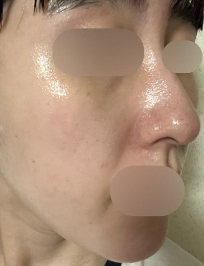 before photo: エレクトロポレーション, ルメッカ