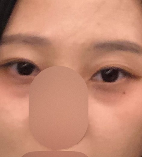 before photo: 눈밑필러