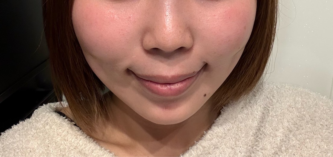 after photo: 脂肪溶解注射(顔)