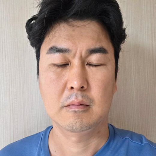 after photo: 눈밑지방재배치