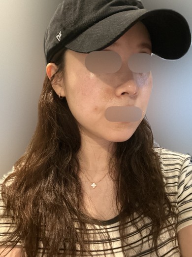 after photo: 점제거시술