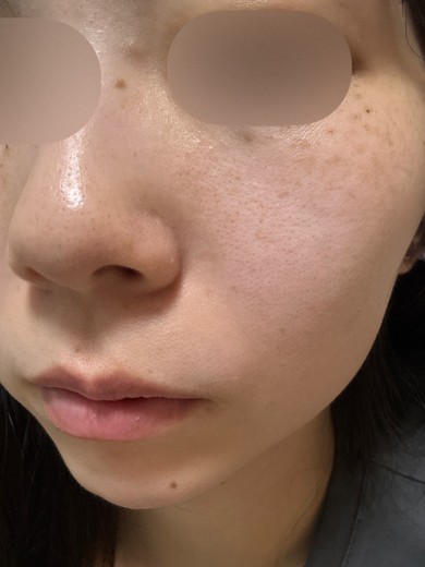 after photo: ハイドラフェイシャル