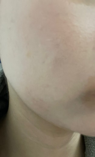 after photo: イオン導入