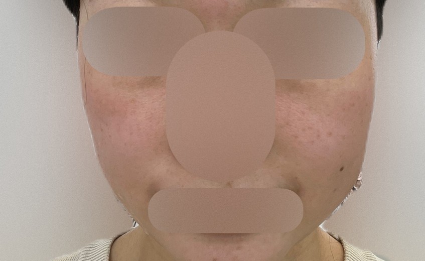 before photo: ハイドラフェイシャル