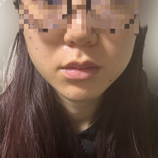 after photo: インモード