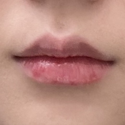 before photo: 입꼬리보톡스