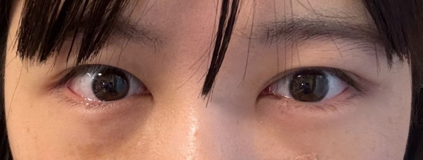 after photo: 目の下脂肪再配置(ハムラ・裏ハムラ法)