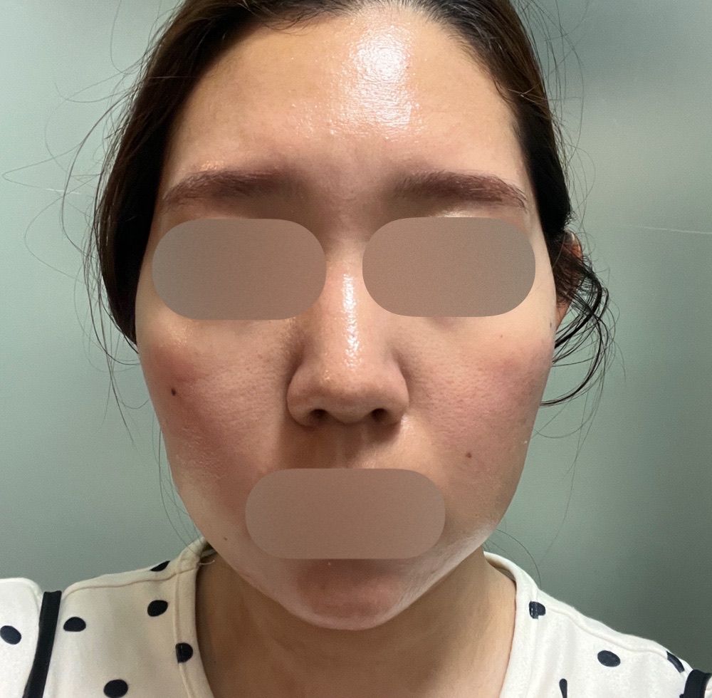 美容機器　専用です！ 何度でも可】【女性限定】顔脱毛｜ジェントルマックスプロ／ジェントル