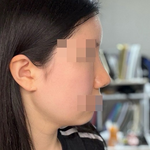 after photo: 코재수술, 콧대(보형물), 복코교정(수술)