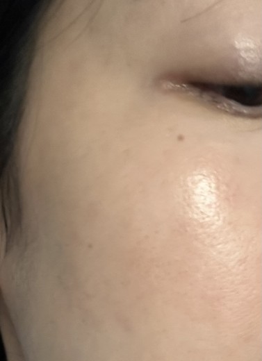 after photo: 스킨보톡스