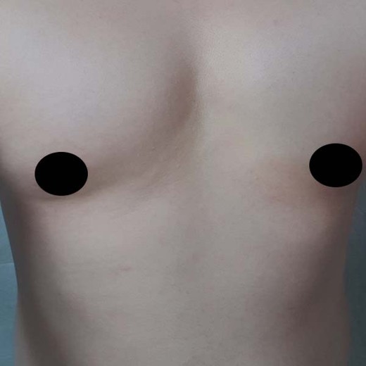 after photo: 여유증수술