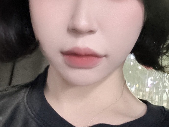 after photo: 콧볼보톡스