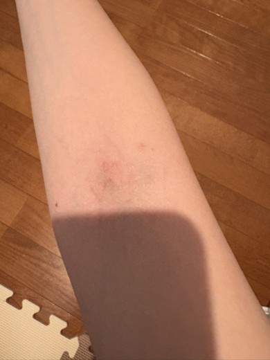 after photo: 美容注射・点滴