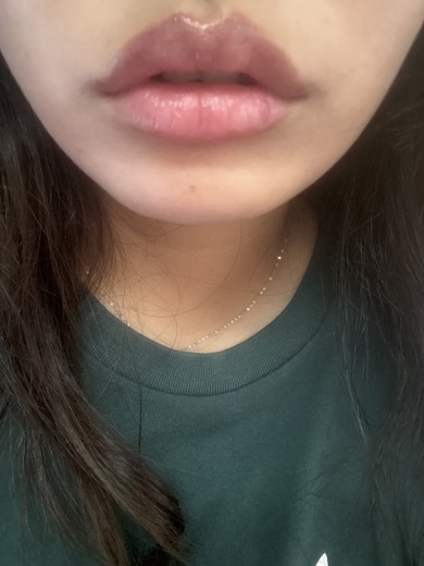 after photo: 입꼬리필러, 입꼬리보톡스