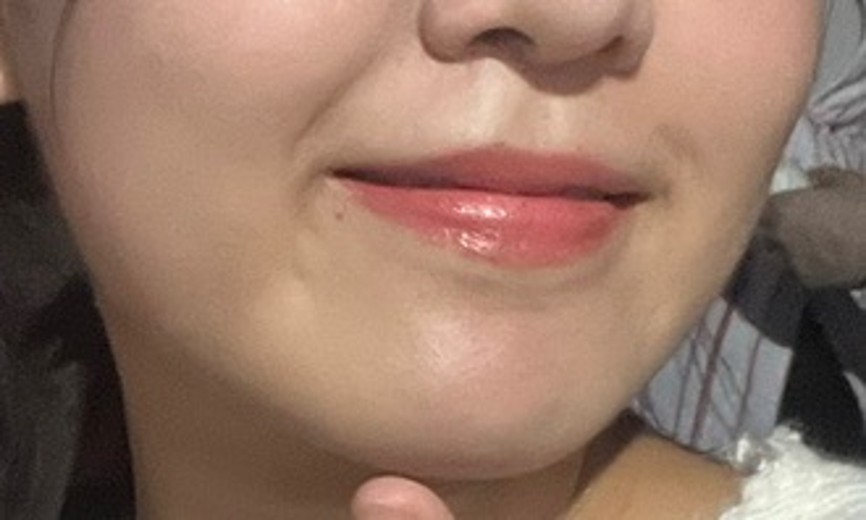 before photo: 윤곽주사