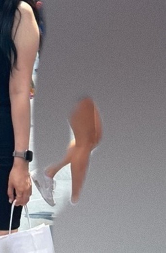 before photo: 팔지방분해주사