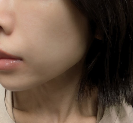 before photo: 糸リフト, メーラー/ジョール/バッカルファット除去