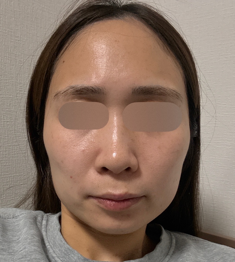 初診限定】ララピール（全顔）＋エレクトロポレーション | 心斎橋KT