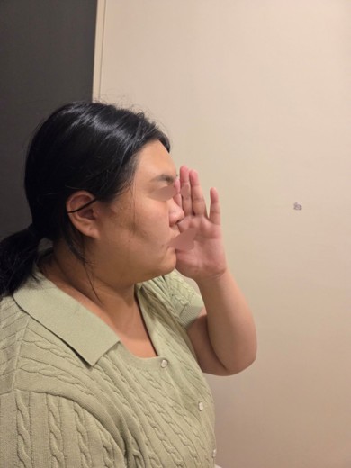 before photo: 비중격만곡증수술, 코끝(보형물)