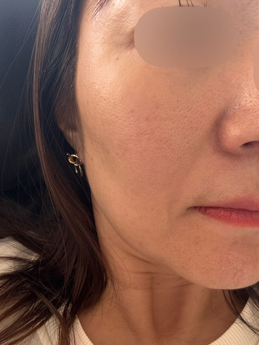 ハイドラフェイシャル＋ケアシス｜トラネキサム酸導入｜全顔 | こまち