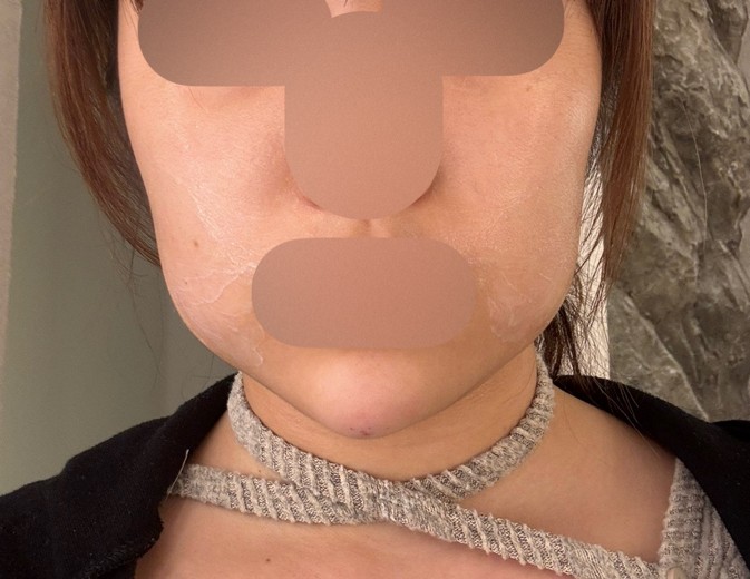 after photo: 턱끝필러