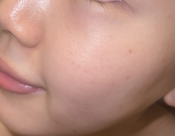 after photo: IPL(光/フォト治療), エレクトロポレーション, ルメッカ