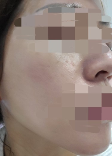 after photo: ハイドラフェイシャル, 診断・検査