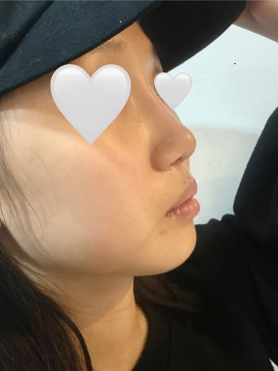 after photo: 비중격만곡증수술, 콧대(보형물), 코끝(자가연골), 비후성비염수술