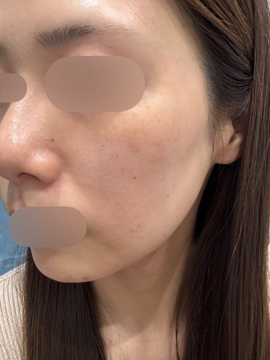 before photo: ルメッカ