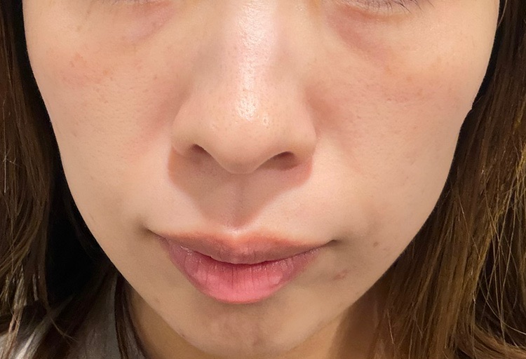 ケミカルピーリング｜全顔｜サリチル酸マクロゴール使用｜肌質改善基礎