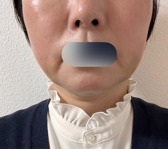 after photo: 脂肪溶解注射(太もも)