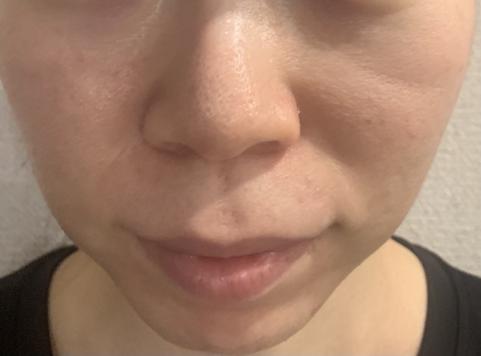 before photo: ダーマペン
