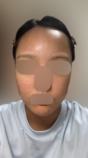 before photo: ダーマペン