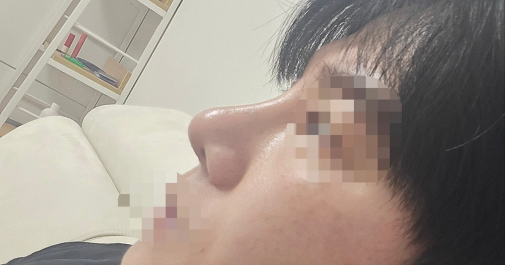 after photo: 비중격만곡증수술