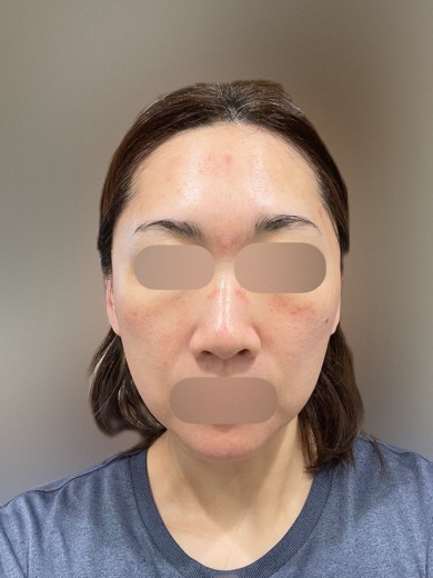 after photo: ヴェルベットスキン