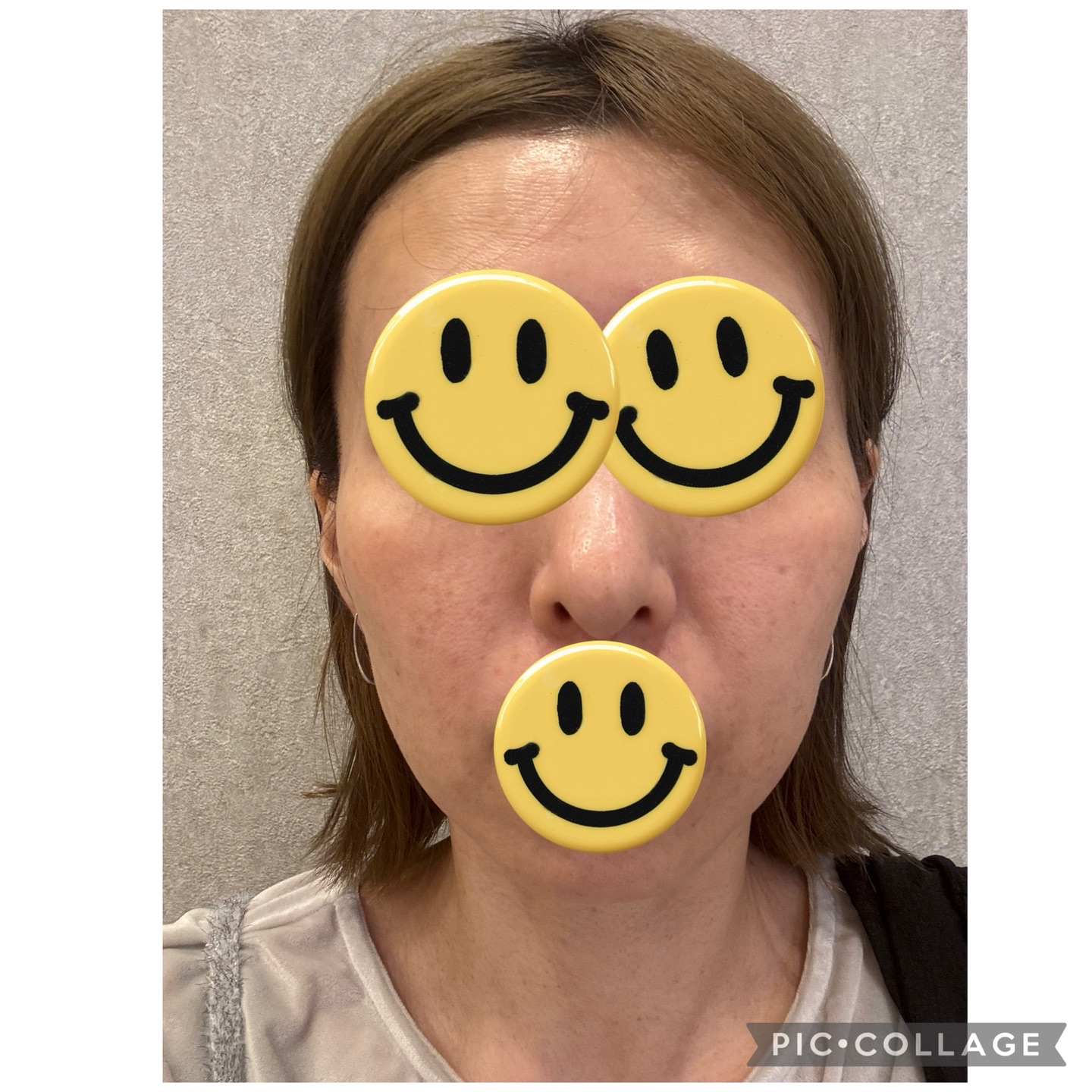 HIFU全顔650shot ウルトラフォーマーMPT【12月29日迄にご予約頂いた方