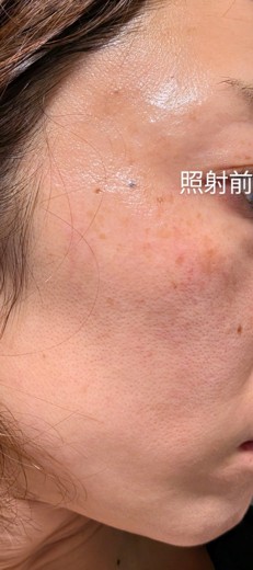 before photo: IPL(光/フォト治療), ルメッカ