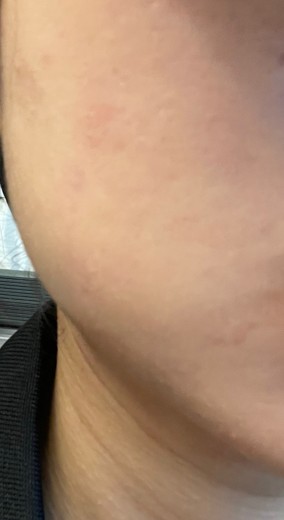 after photo: 인모드리프팅